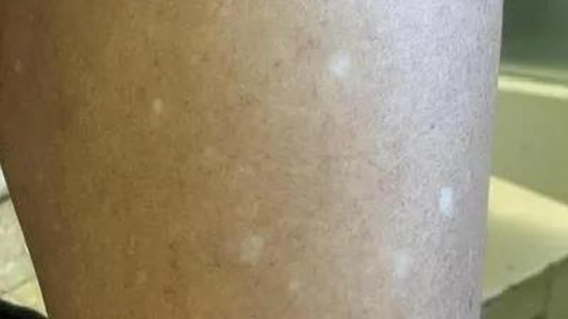 成都白癜风